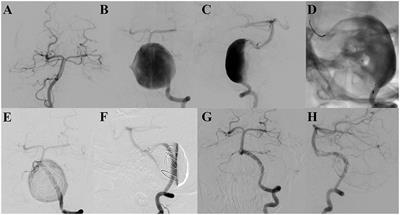 Pipeline embolization devices for the treatment of nonsaccular aneurysms in pediatric patients